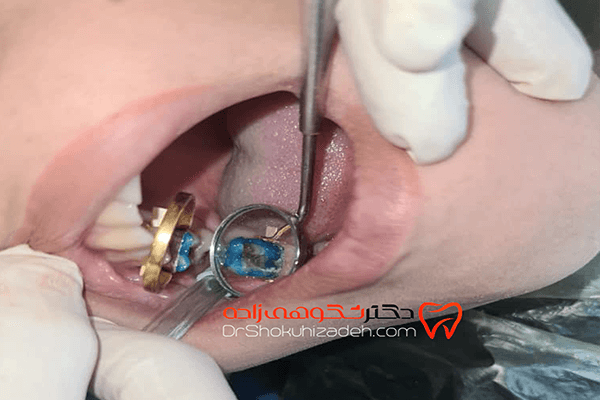 روش‌های ترمیم دندان 