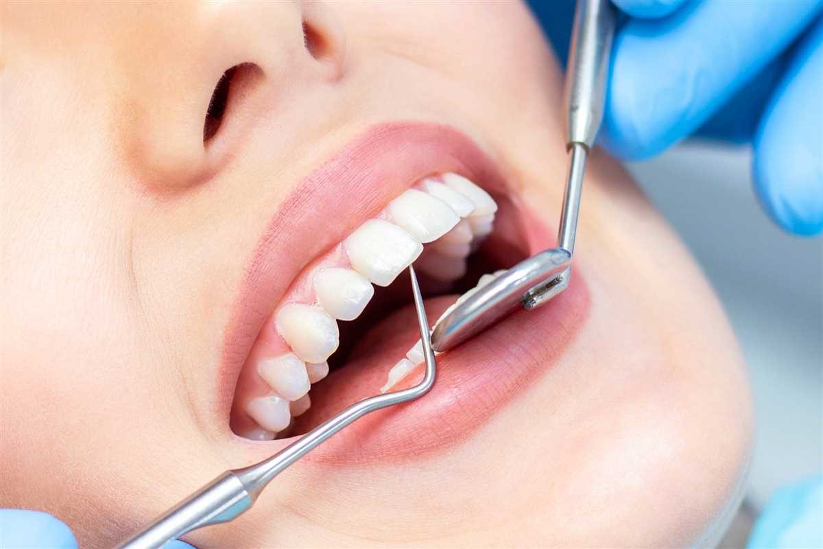 طول عمر کامپوزیت دندان چقدر است؟ 