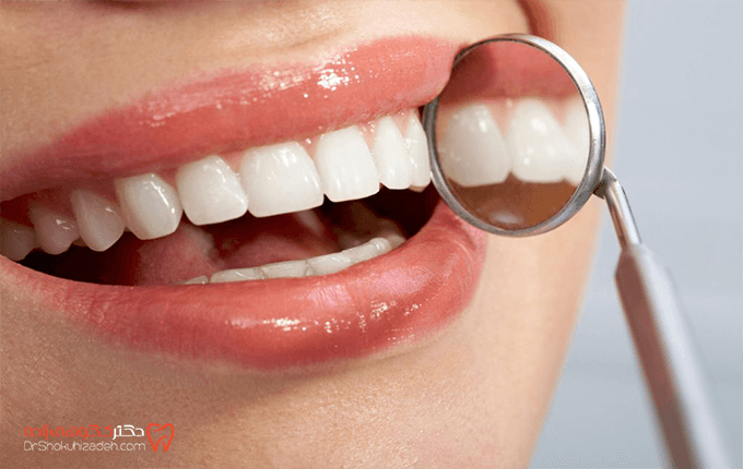 20 روش جرم گیری دندان در خانه