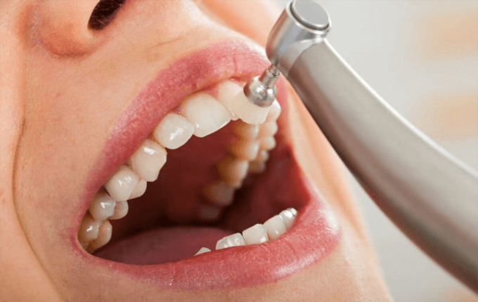 پلاک دندان چگونه تشکیل می شود؟ 