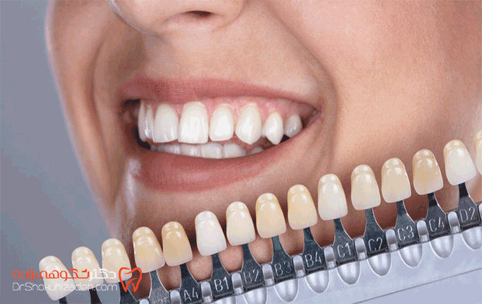 ماندگاری روکش دندان چقدر است؟  