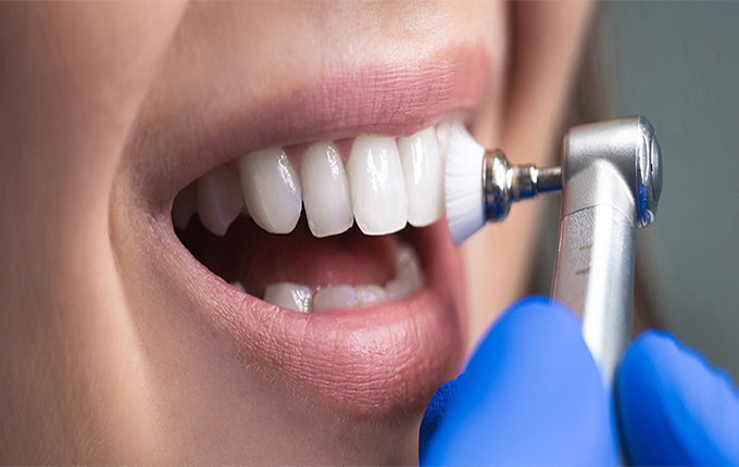  بلیچینگ و جرم گیری دندان چه تفاوتی دارند؟ 