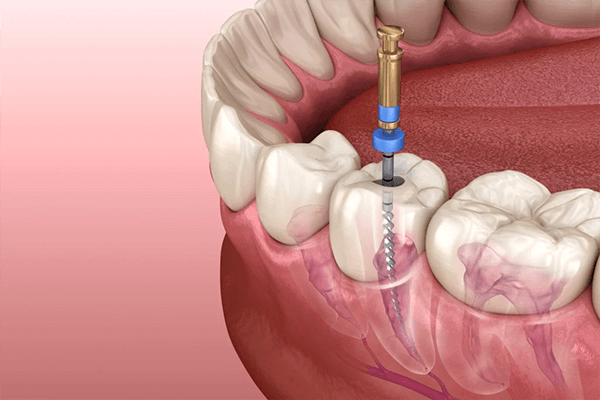 اگر دندان را عصب کشی نکنیم چه می‌شود؟ 