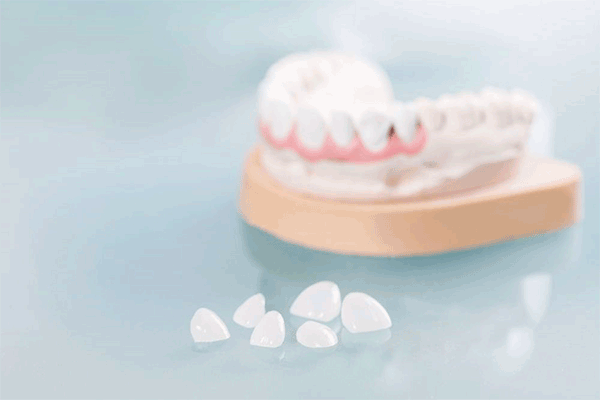 روکش دندان بهتر است یا لمینت؟