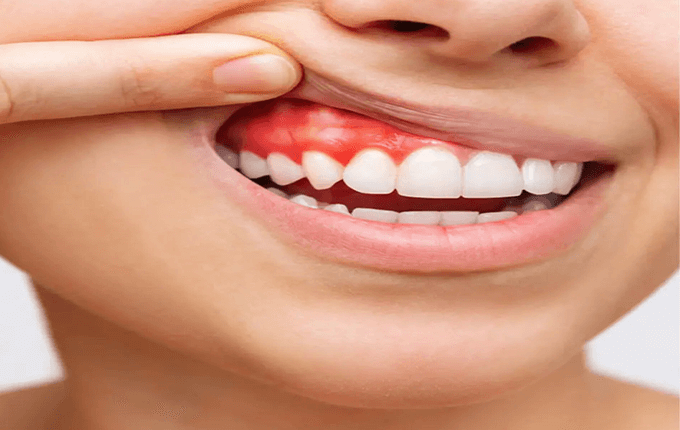 التهاب لثه بعد از کامپوزیت دندان
