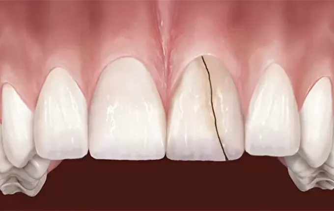 5 دلیل اصلی فرسایش مینای دندان