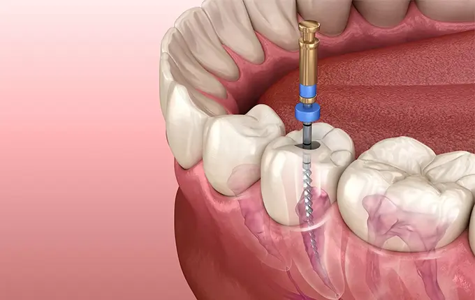 چرا باید بعد از درمان عصب کشی دندان پر شود؟