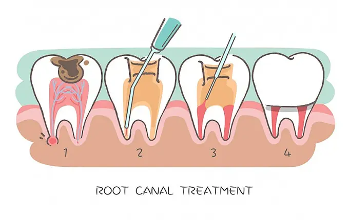 چرا باید بعد از درمان عصب کشی دندان پر شود؟