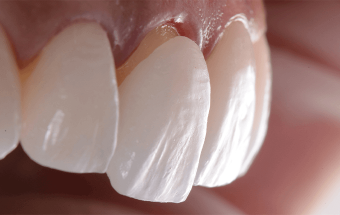 عوامل موثر بر دوام لمینت های دندانی