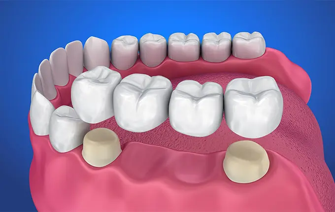 علت استفاده از پروتز متحرک دندان