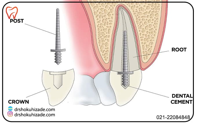 پست و کور دندان چیست؟