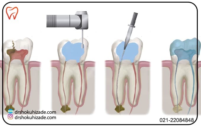 7 مرحله عصب کشی دندان های جلو: