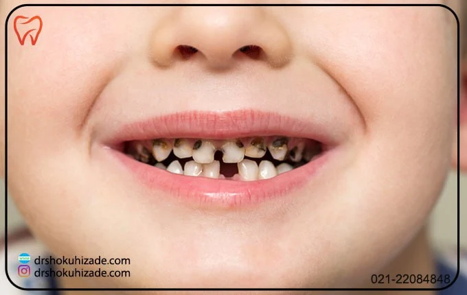 درمان دندانپزشکی لکه های سیاه ناشی از قطره آهن دندان کودکان