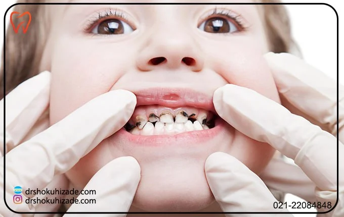 4 روش خانگی برای جلوگیری از سیاه شدن دندان کودکان ناشی از قطره آهن